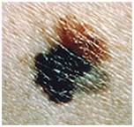 опасные родинки - фото