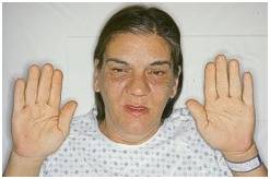 Опухоль гипофиза симптомы у женщин