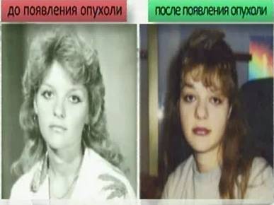 Опухоль гипофиза: симптомы у женщин