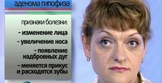 Опухоль гипофиза: симптомы у женщин