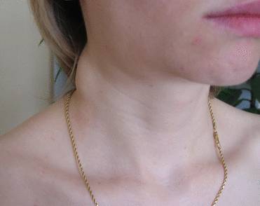 Опухоль лимфатических узлов