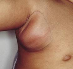 Опухоль лимфоузлов - фото