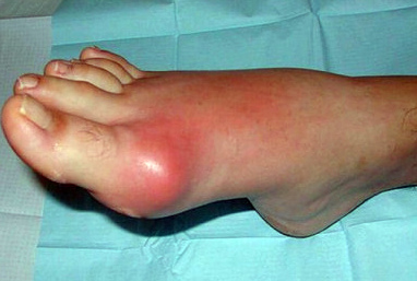 Опухоль пальца ноги
