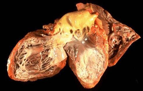 опухоль сердца - лечение