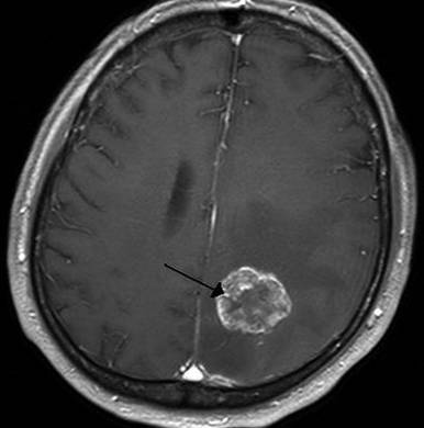 Опухоль в голове