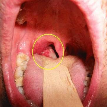 Опухоль в горле: как правильно лечить?