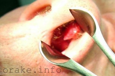 Опухоль в носу - причины образования, лечение, удаление, прогнозы