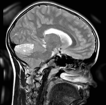 Опухоли головного мозга у детей