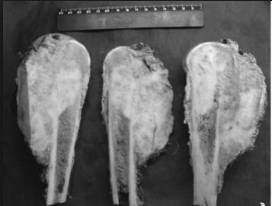 опухоли костной ткани