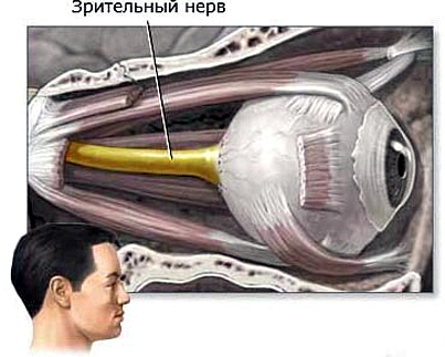 opuxoli zritelnogo nerva