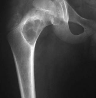 Остеома - фото