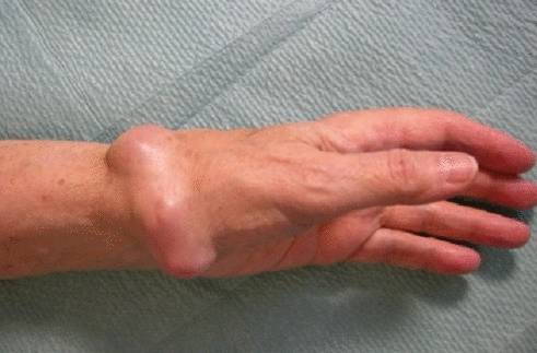 Остеома - фото. Как выглядит остеома?