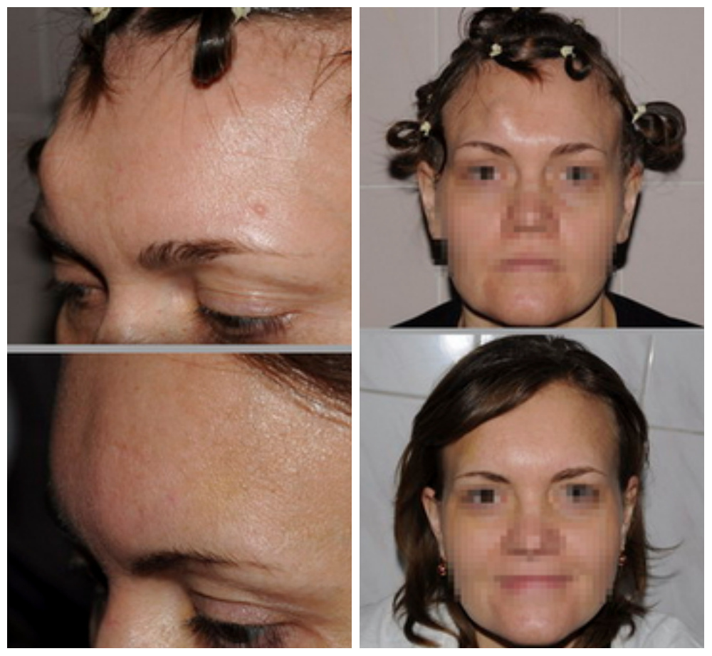 Остеома кости