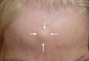 Остеома кости