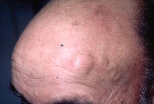 Остеома - фото