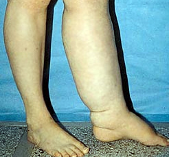 Отек ног при раке