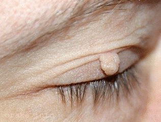 папилллома на глазу