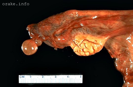 paraovarialnaya kista pri beremennosti