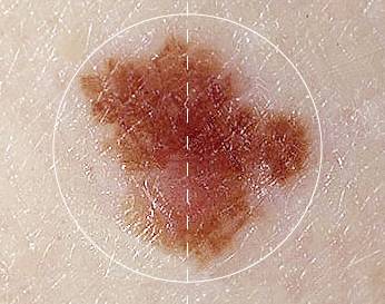 плоские родинки опасны