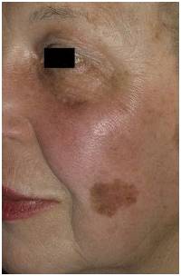 плоские родинки