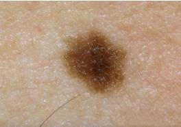 плоская родинка