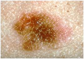 плоские родинки