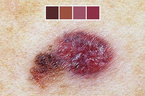 почему растет родинка