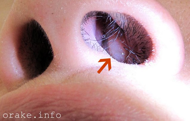 polip v nosu mozhet perejti v rak