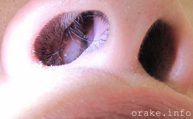 polipoz nosa perexodit v rak