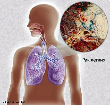 predrakovoe sostoyanie legkix