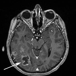 Признаки головной опухоли