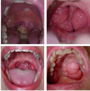 Признаки рака горла у женщин