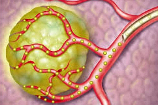 radioembolizaciya raka