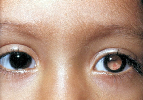 Рак глаз у детей