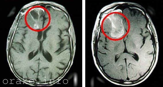 Рак головного мозга у детей