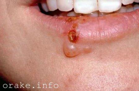 Рак губы начальная стадия