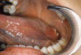 Рак корня языка: симптомы (фото)