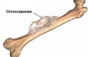 Рак кости бедра