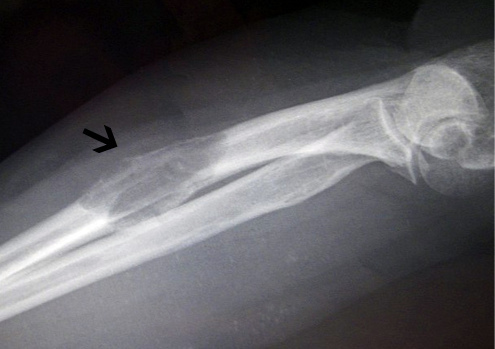 Рак кости ноги