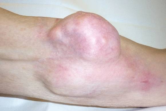 Рак костной ткани