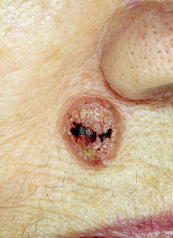 Рак кожи лица