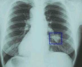 Рак легких с метастазами - сколько живут?