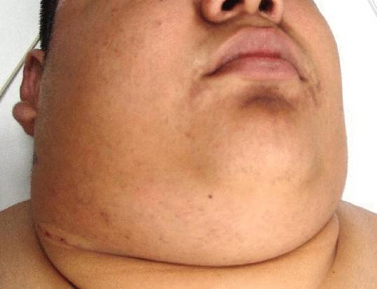 Рак лимфы. Фото и прогноз при раке лимфы