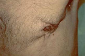 rak molochnoj zhelezy u muzhchin - foto