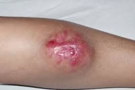 Рак мышечной ткани