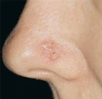 Рак носа: фото, признаки, лечение