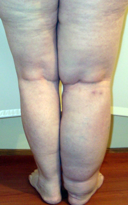 Отек ноги при онкологии