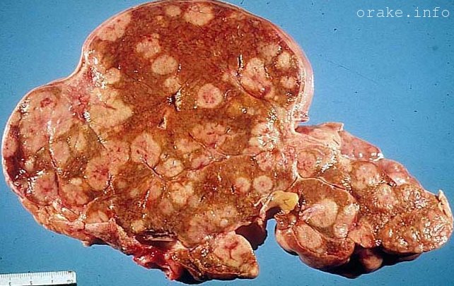 rak pecheni 4 stepeni skolko zhivut