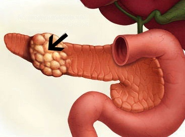 Рак поджелудочной головки