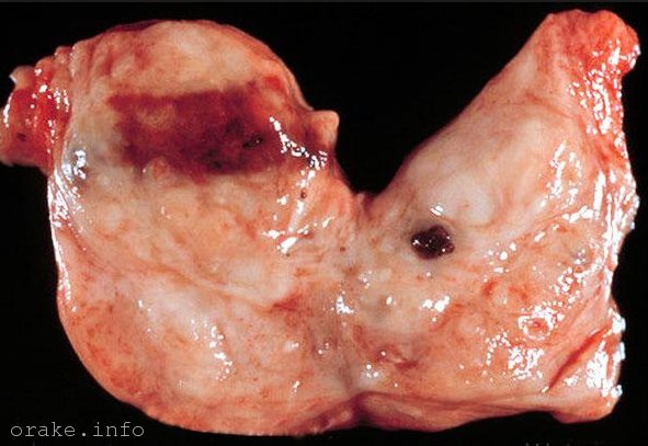 рак предстательной железы народное лечение